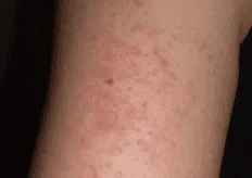 lulotox side effects