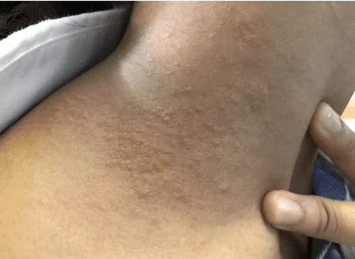 Neck Rash