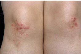 knee rash