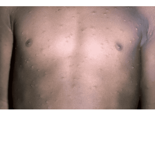Chest Rash