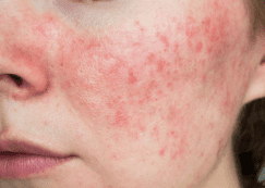 face rash