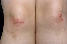 knee rash