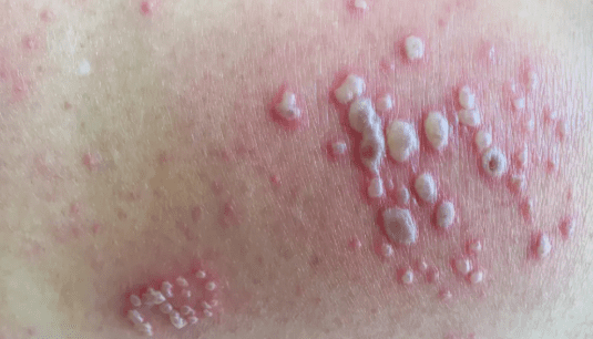 skin irritation