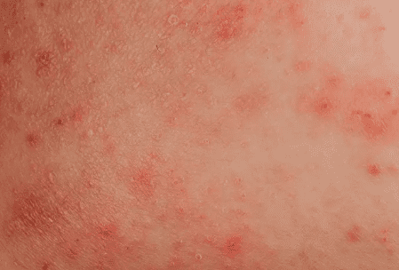 stomach rash