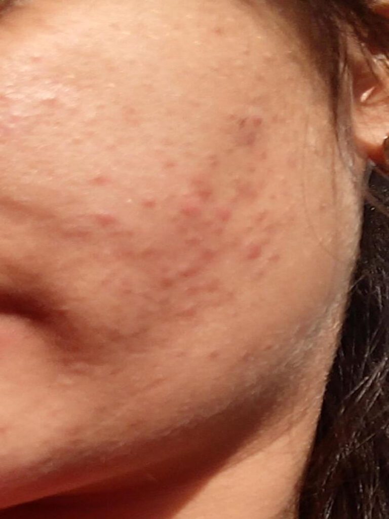 Erythematous papules on the left cheek with no complaints of itching burning or pain on