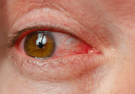 Red eye