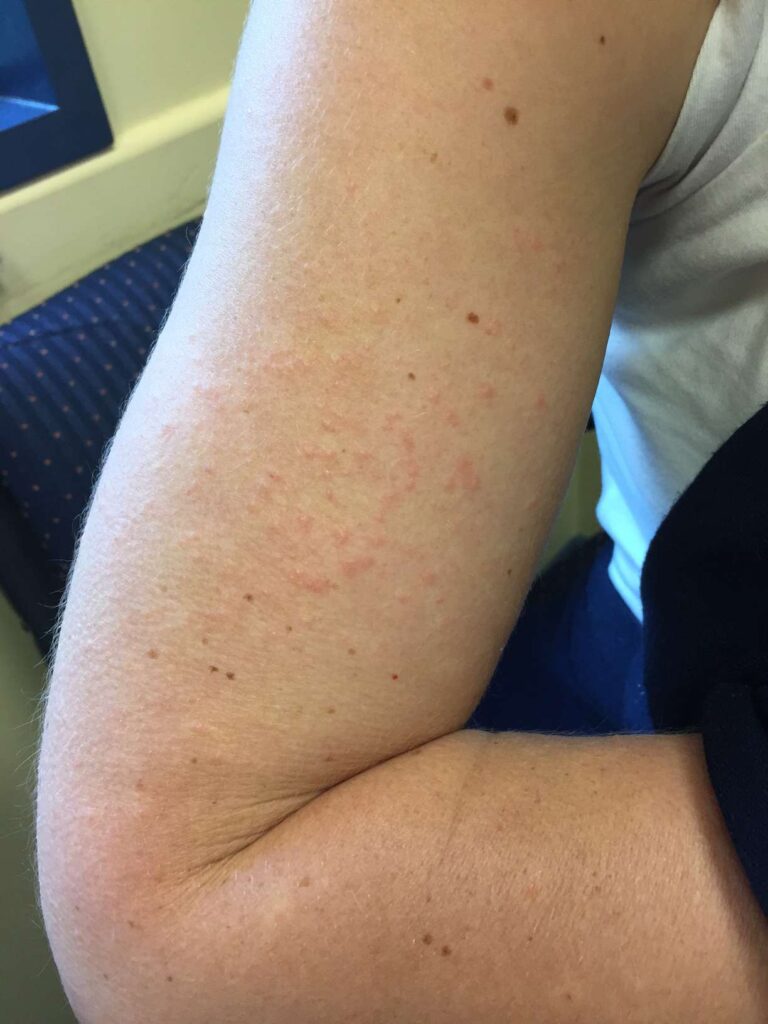 VWH DermNetNZ Mononuclueosis 01 d8dbc8fca007472094628b99a7d8c702