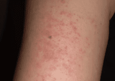 arm rash