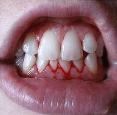 bleeding gums