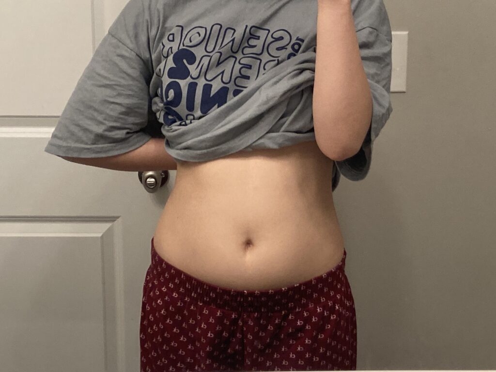 bloating