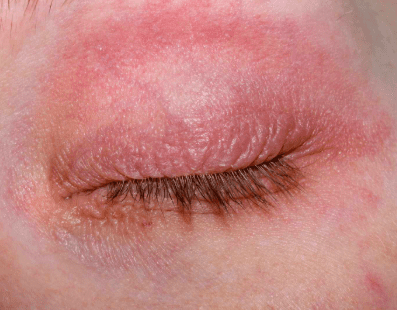eye rash