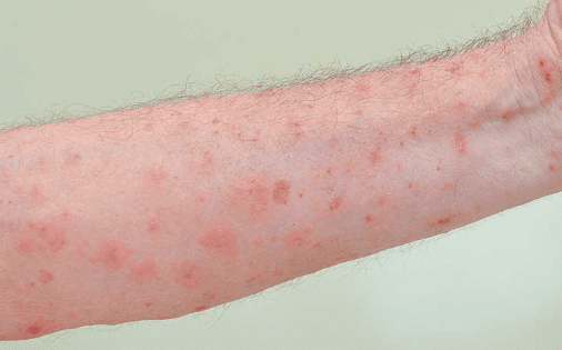 hand rash