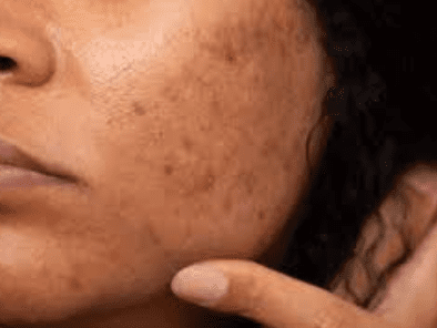 hyperpigmentation