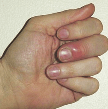 nail boil