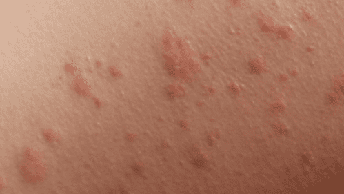 rash