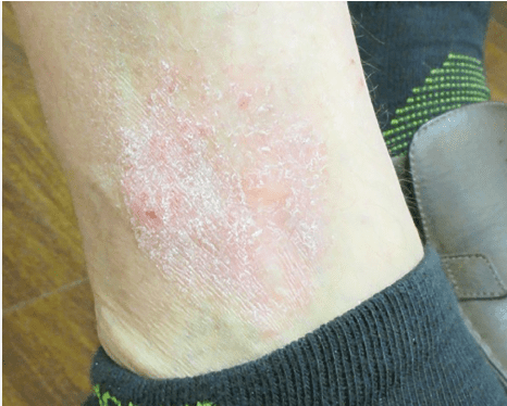 rash on leg