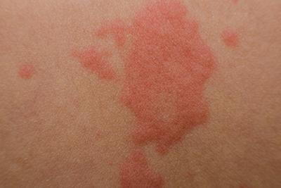 rashes