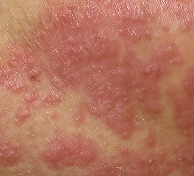 skkin rash