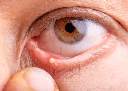 swollen eye