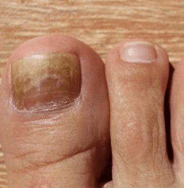 toe fungus