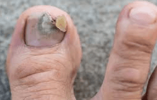 toe nail fungus