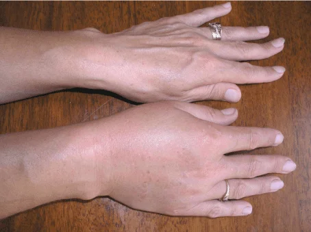 nerve alive hand swelling