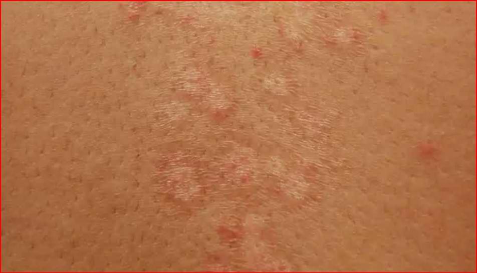 Skin allergy
