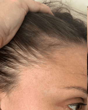 Hair Thinning