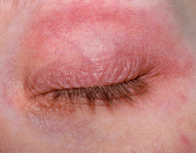 eye rash