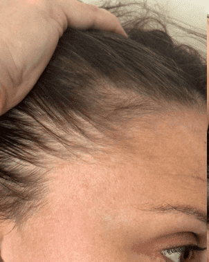 Hair Thinning