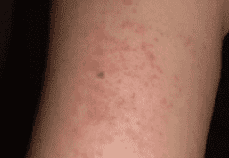 allergy