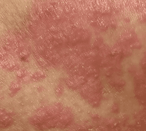 allergy 
