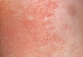 derma essential side effects