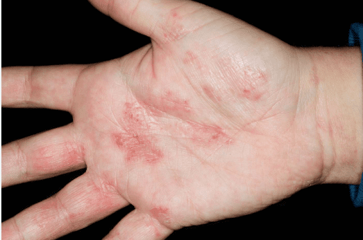 nervehand