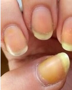 Brittle nails