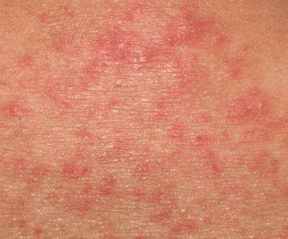 rashes