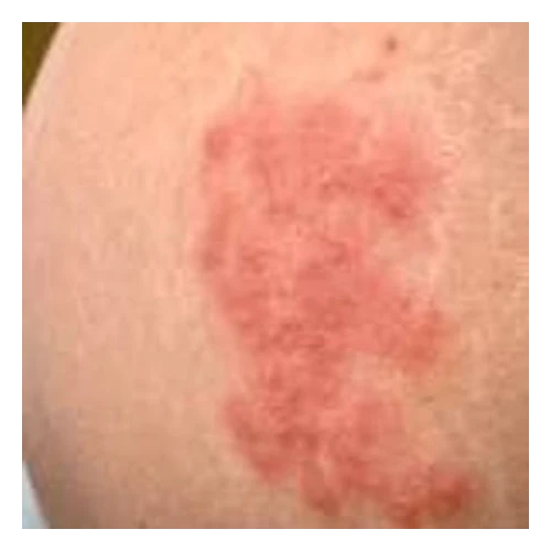 Customer having severe rash after taking CinnaChroma supplement