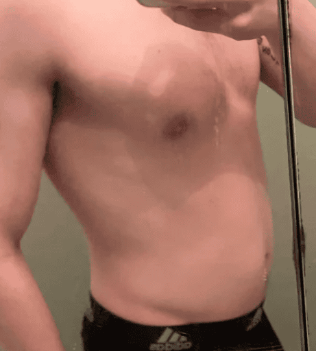bloating 