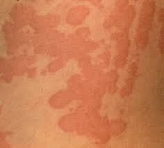 Customer having severe rash after taking AlphaSteel supplement