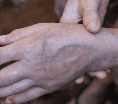 swollen hands