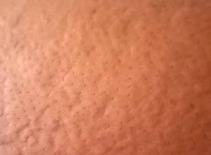 liver coomplex itchy skin