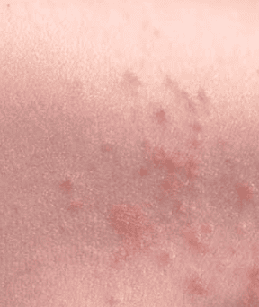 nerve zen caused me rashes