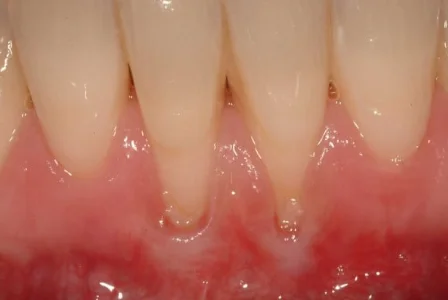 weak gums