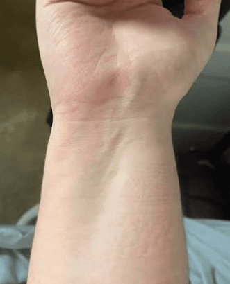 swelled hands