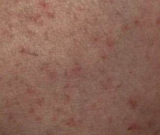 red pigments as a side effect of gutsave