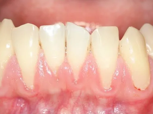gums receeding