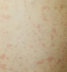 rashes on hand