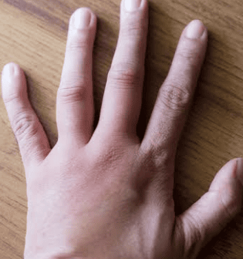 Swelling hands