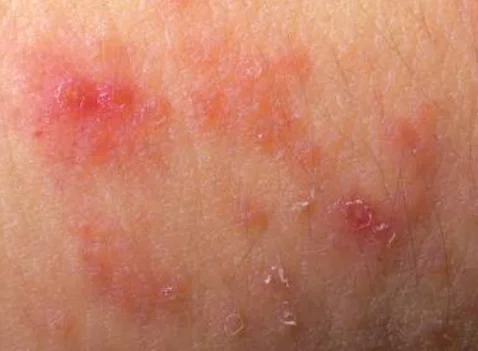 itching side effects reset sugar drops