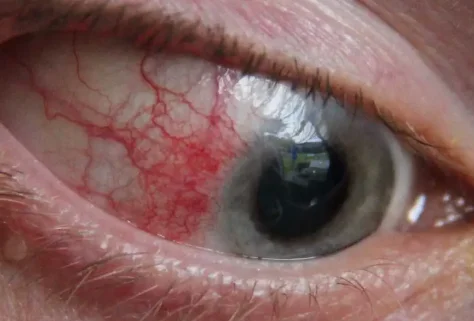 red eyes